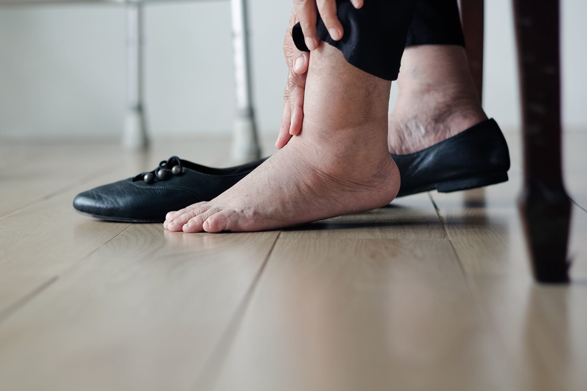 Swollen ankles - sign of heart problems