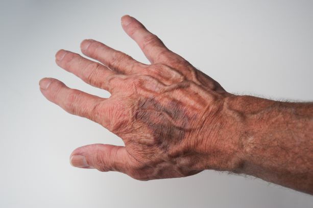 Understanding Elderly Bruising and Risk Prevention